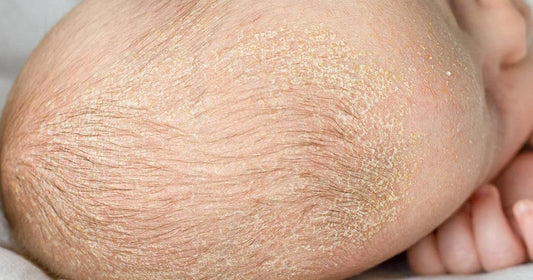 Croûtes de lait du bébé: causes, symptômes, durée et plus encore - Clinique à Deux Cheveux