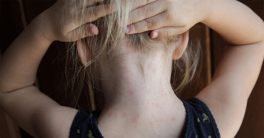 Comment soigner l'eczéma du cuir chevelu chez les enfants - Clinique à Deux Cheveux