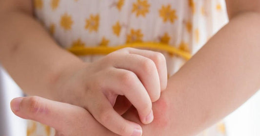 Comprendre le psoriasis du cuir chevelu chez les enfants - Clinique à Deux Cheveux