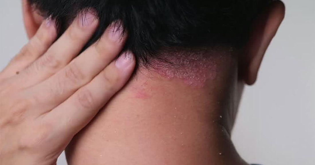 Quoi faire pour calmer et lutter contre les démangeaisons liées au psoriasis? - Clinique à Deux Cheveux