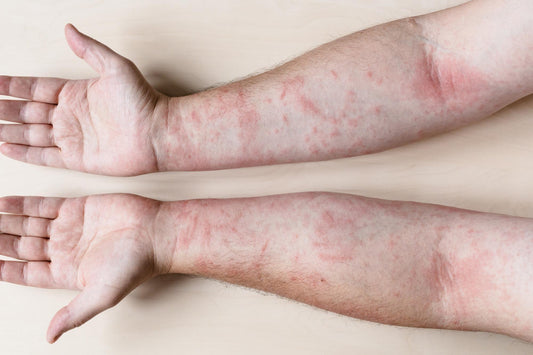 Est-ce possible de soulager l’eczéma du corps et des mains?