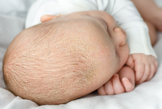 bébé qui fait du chapeau connu sous le nom de dermatite séborrhéique