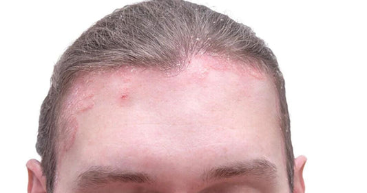 Quoi faire pour calmer et lutter contre les démangeaisons liées à la dermatite atopique? - Clinique à Deux Cheveux