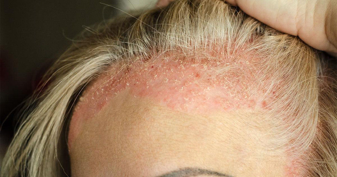 Psoriasis: causes, symptômes et options de traitements - Clinique à Deux Cheveux