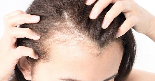 Femme avec perte de cheveux post-partum
