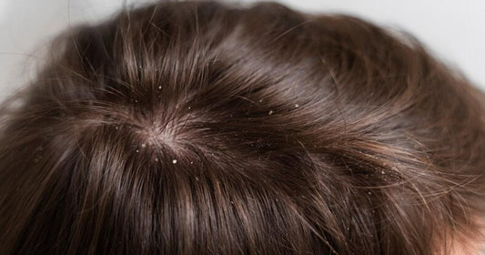 Cuir chevelu sec enfant: Pistes à explorer pour trouver les causes - Clinique à Deux Cheveux