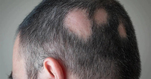 La Pelade: mieux comprendre ce trouble dermatologique auto-immune - Clinique à Deux Cheveux