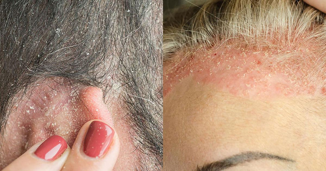 Quelles sont les différences entre le psoriasis et l’eczéma ? - Clinique à Deux Cheveux