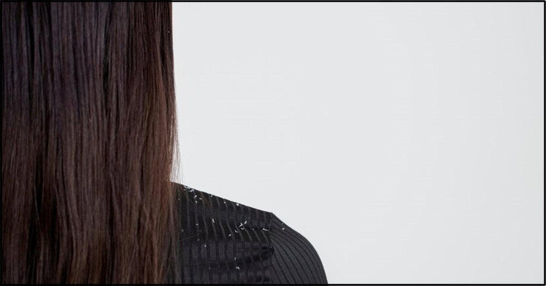 Pellicules Sèches ou Psoriasis: Découvrir Les Différences Clés - Clinique à Deux Cheveux
